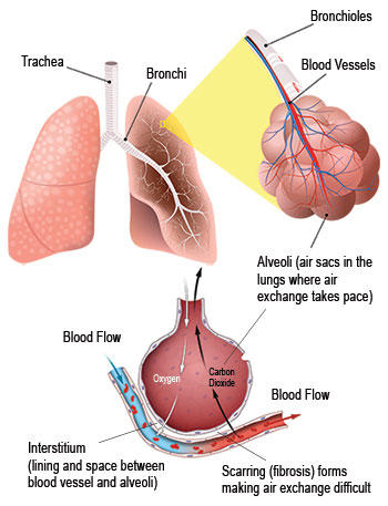 间质性肺疾病(ILD)肺和肺泡图