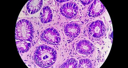 结肠直肠癌的微观图像