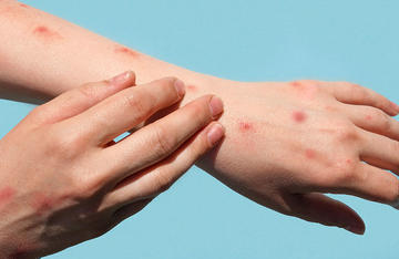 手臂和手上的猴痘疹
